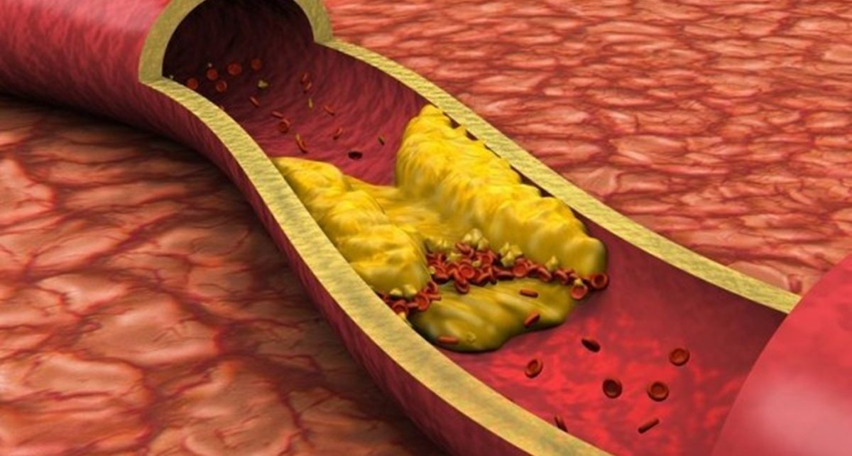 7 Cara Menurunkan Kolesterol Secara Alami