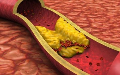 7 Cara Menurunkan Kolesterol Secara Alami