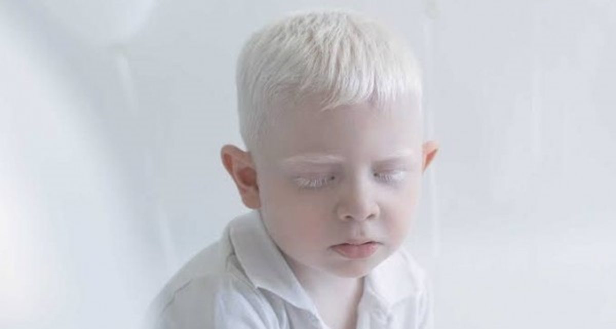 7 Masalah Kesehatan yang Sering Diderita Albino